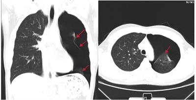 Application of multimodal analgesia combined with opioid-free anesthetics in a non-intubated video-assisted thoracoscopic surgery bullectomy: A case report